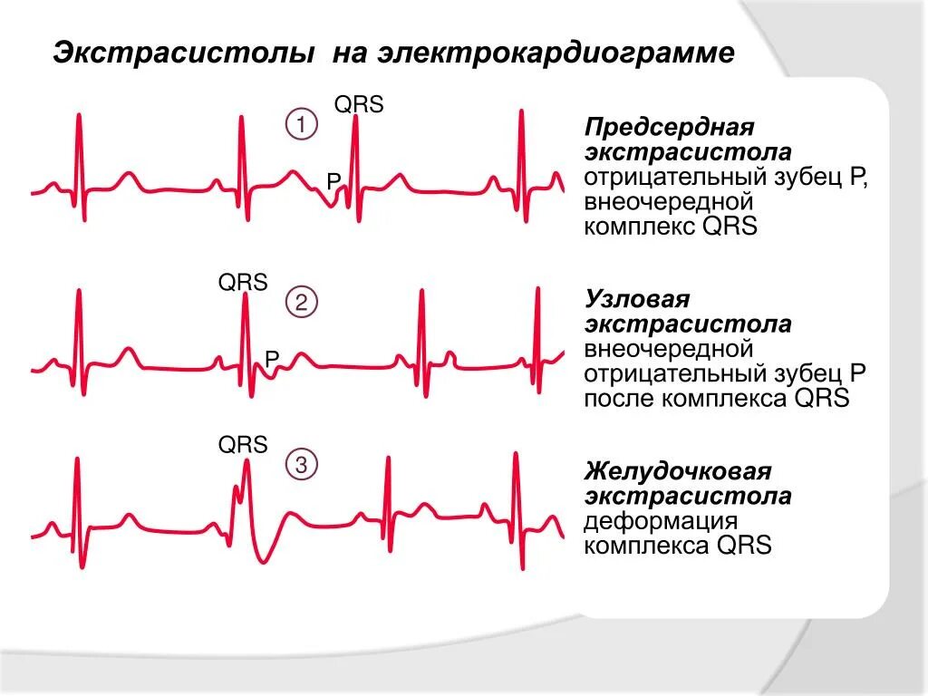 Суправентрикулярная экстрасистолия на ЭКГ. Предсердные и желудочковые экстрасистолы на ЭКГ. Одиночная наджелудочковая экстрасистолия на ЭКГ. Желудочковые экстрасистолы на ЭКГ. Будет ли опасность в моем сердце 3
