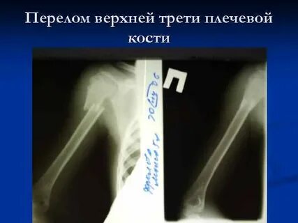 Закрытый перелом кости без смещения мкб