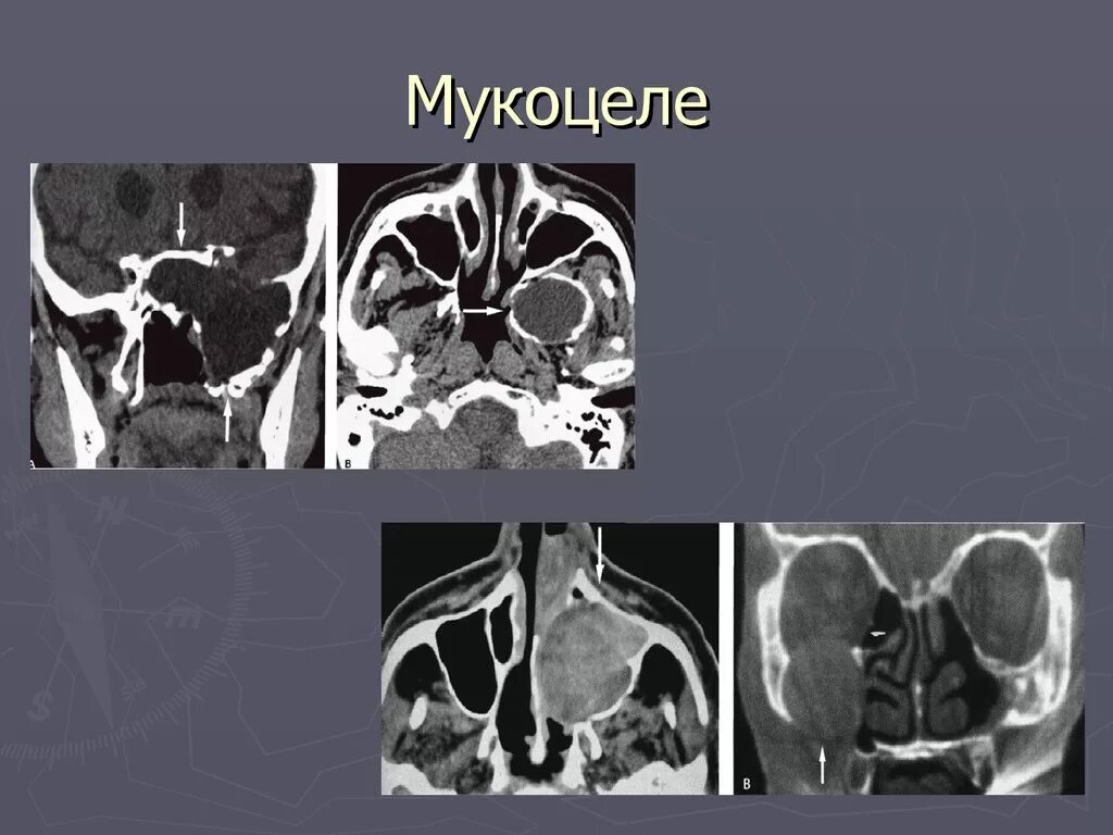 Мукоцеле лобной пазухи на кт. Мукоцеле верхнечелюстной пазухи. Мукоцеле верхнечелюстной пазухи мрт. Мукоцеле синуса. Мукоцеле гайморовой пазухи кт.