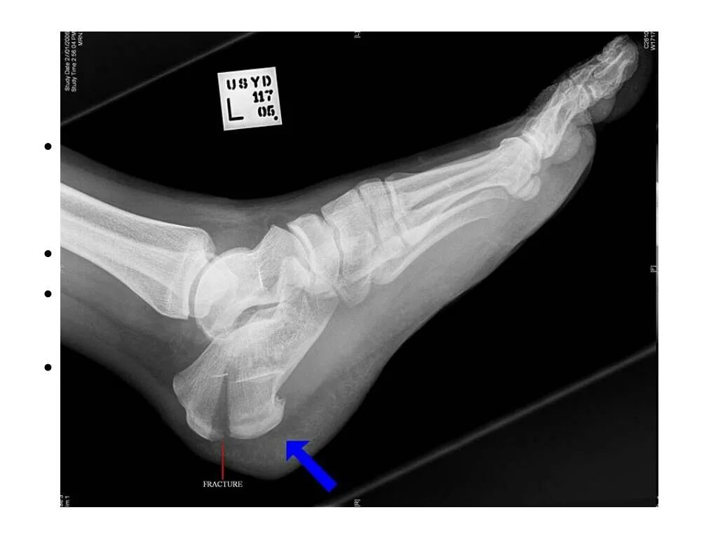 Операция пяточной кости. Перелом пяточной кости рентген. Пяточная кость рентген перелом. Перелом пяточной кости рентген снимки. Рентген здоровой пяточной кости.