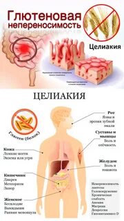 Глютеновая непереносимость