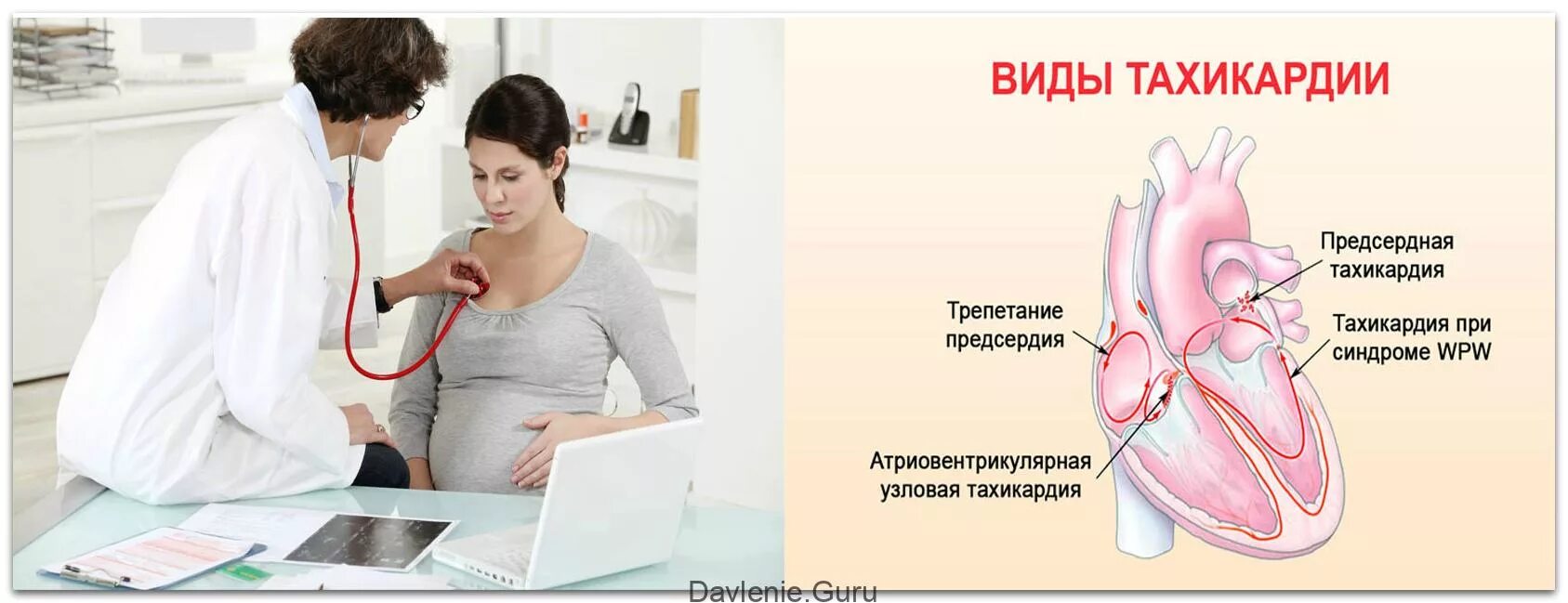 Пульсация во время беременности. Сердцебиение беременной. тахикардия у беременных. частое сердцебиение при беременности. тахикардия сердца у беременных.