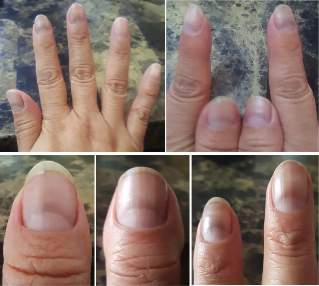 Заболевания ногтевой пластины. Пожелтение ногтевой пластины. Болезни ногтевой пластины на руках. Почему посинели ногти