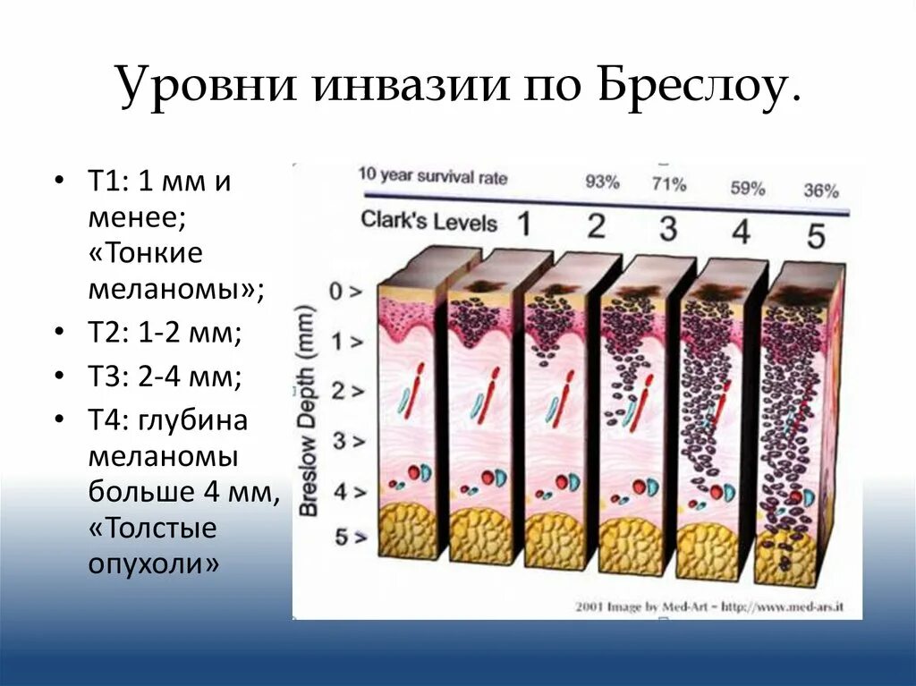 Степень глубины. Толщина опухоли по бреслоу меланома. степень инвазии по кларку меланома. глубина инвазии по бреслоу-1,1мм. уровни инвазии меланомы по кларку.