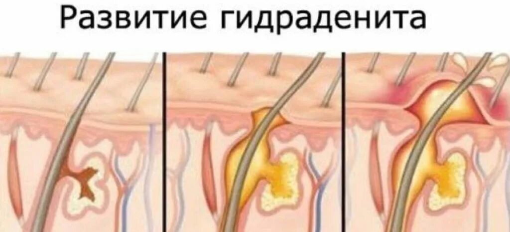 Почему постоянно воспаляется. Аксиллярный гидраденит. Воспаление потовой железы - гидраденит. Нагноение волосяного фолликула. Фолликулит волосяного фолликула.