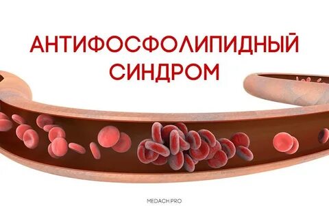 Синдром антифосфолипидных антител
