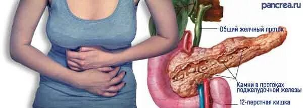 Камри в подделудочной железе. Камень поджелудочная железа что делать. Конкременты панкреатического протока. Камень поджелудочная железа что делать. Камни поджелудочной железы.