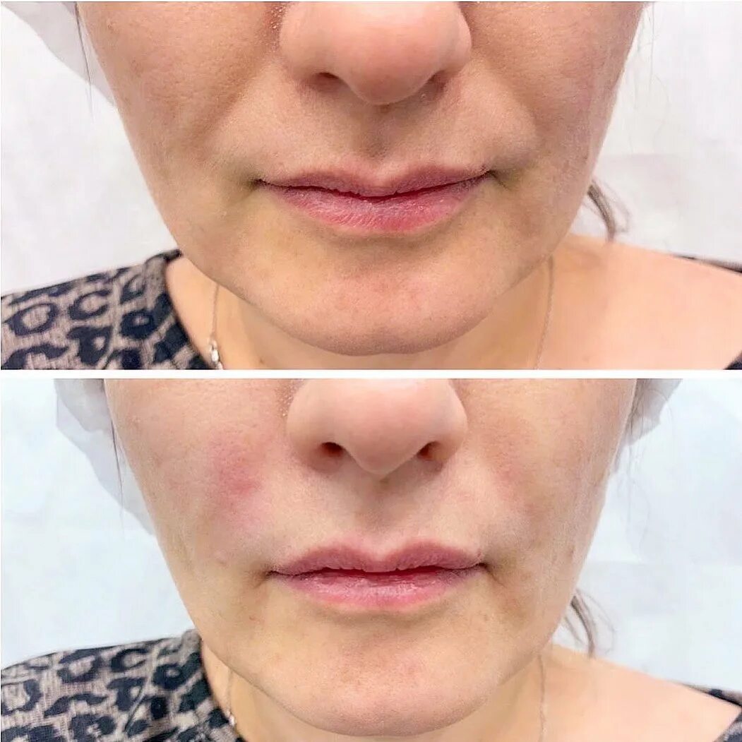 Косметолог носогубные складки. Носоносогубные складки. Рестилайн носогубные складки. Косметолог носогубные складки. Операция на носогубные складки.