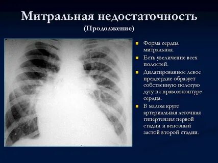 Митральное сердце