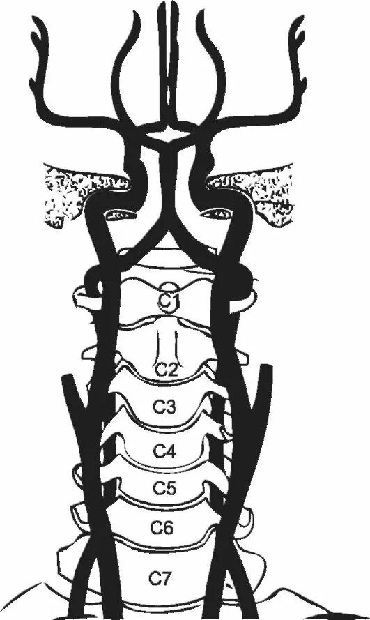 синдром вертебробазилярной артерии. базилярный кровоток. базилярный кровоток. базилярный кровоток. базилярный кровоток.