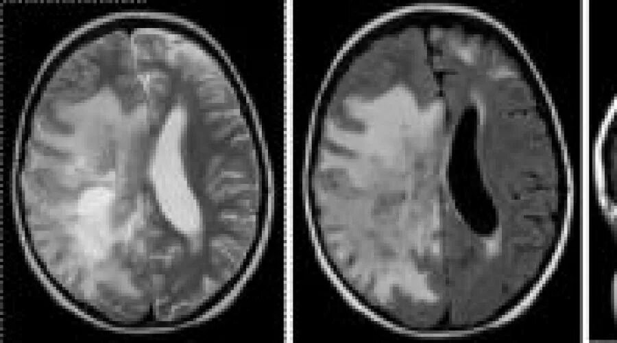 Лейкоэнцефалит. Энцефалит шильдера мрт. подострый энцефалит мрт. лейкоэнцефалит шильдера мрт. острый геморрагический лейкоэнцефалит.
