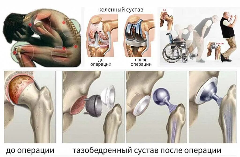 Эндопротезирование отзывы пациентов после операции. Операция эндопротез тазобедренный. Протезирование тазобедренного сустава ход операции. ТБС тазобедренного сустава. Эндопротез плечевого сустава Тотальный реверсивный.