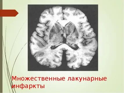 Лакунарный инфаркт