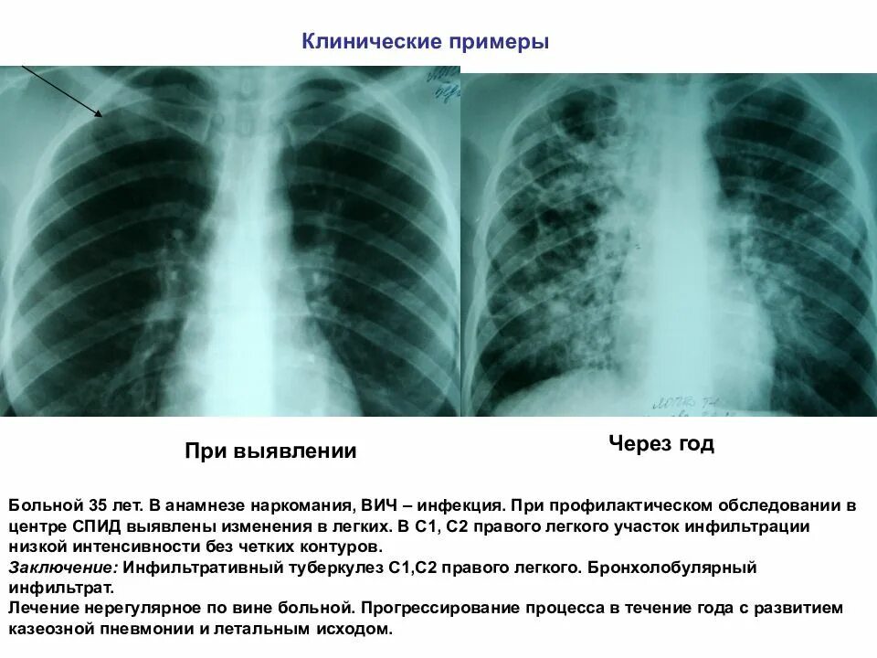 Инфильтративный туберкулез легкого с1-2. Инфильтративный туберкулез рентген. Очагово-инфильтративный туберкулез рентген. Туберкулез в с2 левого легкого.