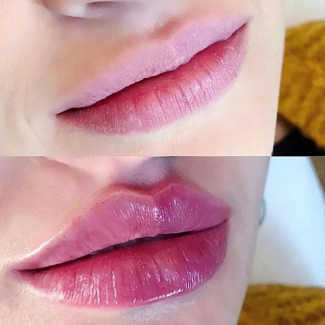 Губы арка. Губы арка. Формы губ для увеличения гиалуроновой кислотой. Губы арка. Губы арка.