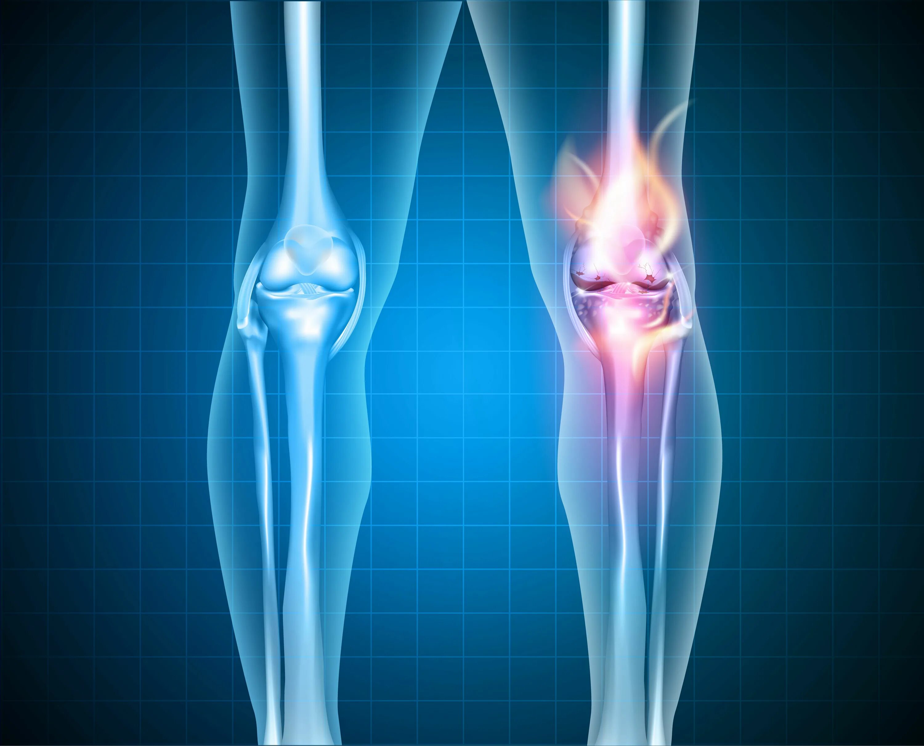 Изменения в коленных суставах. Анкилоз локтевого сустава. Деформирующий остеоартрит. Здоровые колени. Остеоартрит коленного сустава.