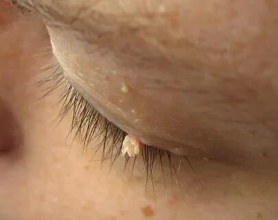 File:Wart filiform eyelid.jpg - Wikipedia 