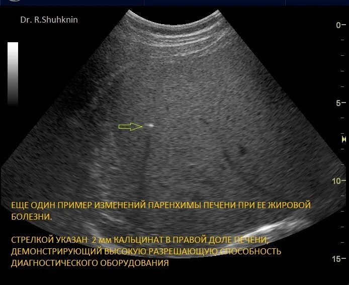 УЗИ признаки жирового гепатоза. Жировой гепатоз печени на УЗИ. Кальцинат правой доли печени