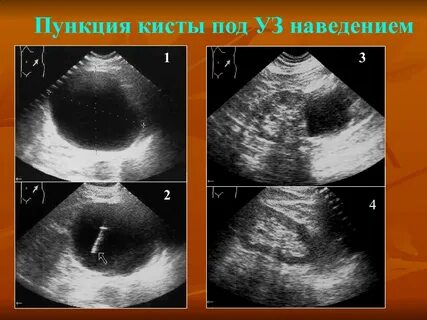 Киста в мм