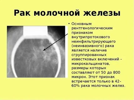 Уплотнение в соске у девочки