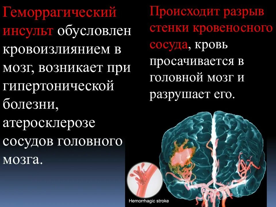 Болезни головных сосудов. Головной мозг при гипертонической болезни. Геморрагический инсульт разрыв сосуда. Геморрагический инсульт сосуд разрывается. Кровоизлияние в головной мозг при гипертонической болезни.