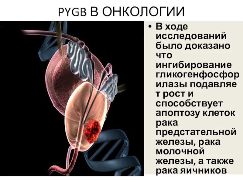 Простата рак симптомы лечение. Клетки предстательной железы. Раковые клетки простаты. Простата раковы клетки.