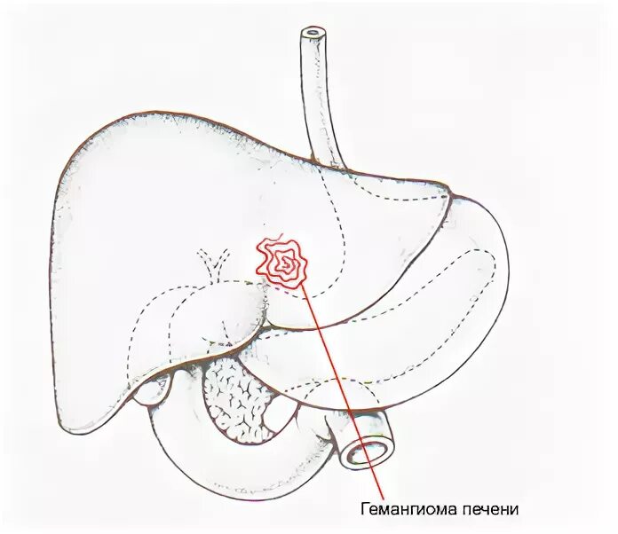 При гемангиоме печени можно ли. Кавернозная гемангиома печени. Кавернозная гемангиома печени кт. Гемангиома левой доли печени.