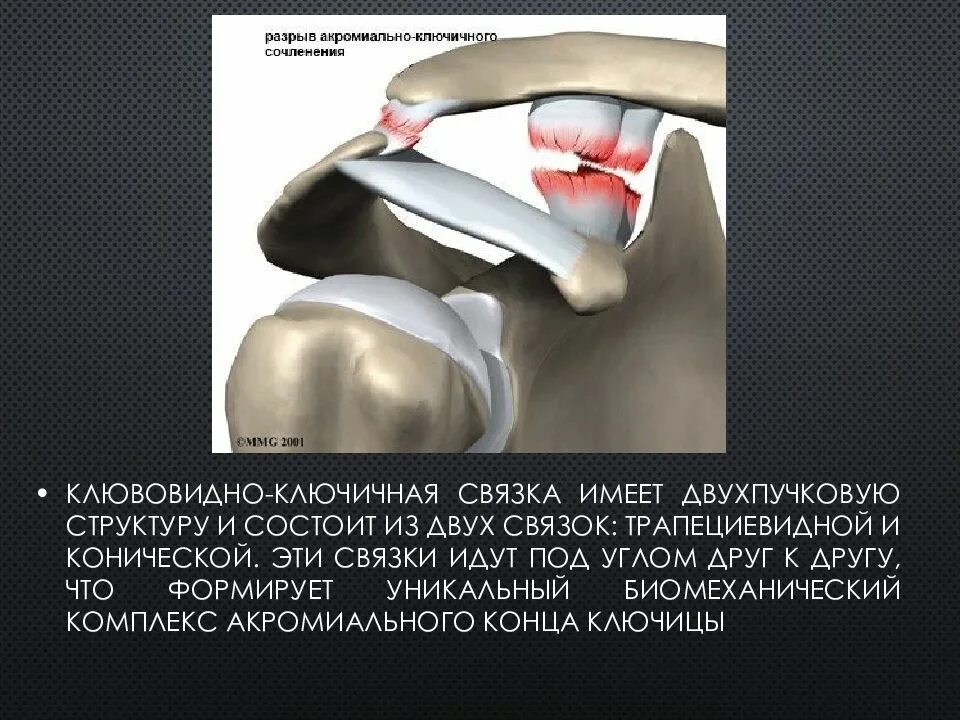 Разрыв сочленений. Акромиально-ключичный сустав разрыв связок. Обызвествление акромиально-ключичной связки. Связки акромиально-ключичного сочленения. Повреждение связок акромиально ключичного сустава.