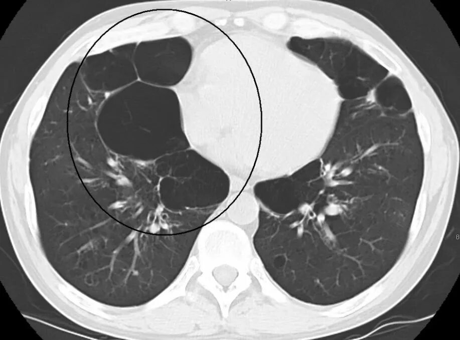 чертежи пистолета тт-33. тульский токарев пистолет чертёж. пневмония на кт легких при короновирусной инфекции. локальный пневмофиброз кт. тт легких.