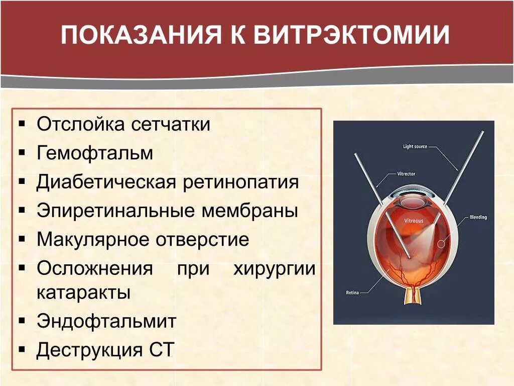 Витрэктомия показания. Отслойка сетчатки витрэктомия. Ретровитреальный гемофтальм это. Стекловидное тело операция