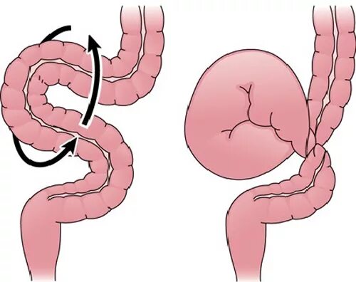 Заворот кишок (инвагинация). Изгиб кишечника