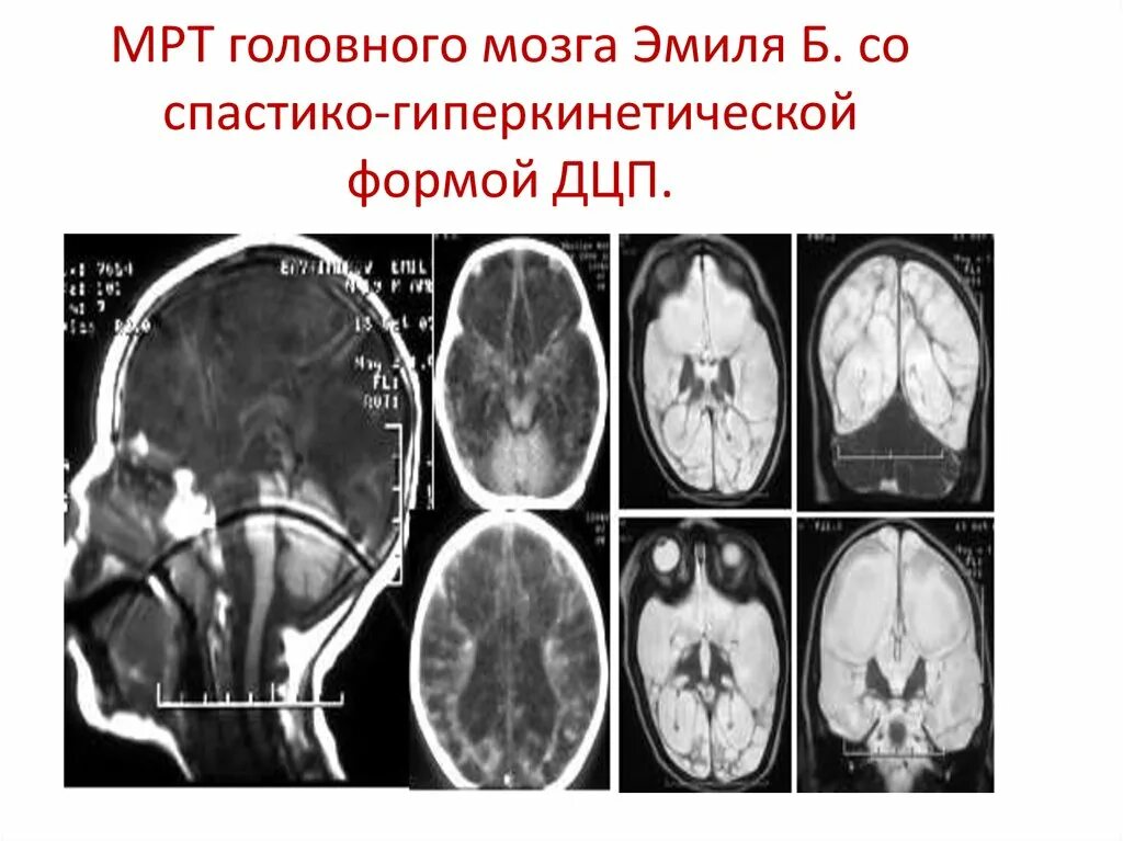 Дцп мозг. Кт головного мозга ДЦП. Мрт головного мозга при ДЦП. Кт головного мозга при ДЦП. ДЦП мрт.