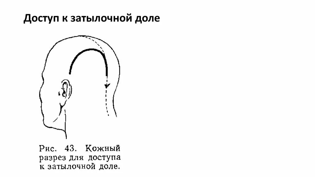 Доступ к затылочной доле. Трепанация доступы к затылочной долей. Доступ. Затылочные рога