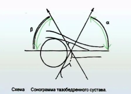 Типы тазобедренных суставов по графу