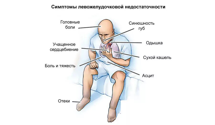 Признаки сердечной недостаточности. Причины острой левожелудочковой сердечной недостаточности. Проявления хронической левожелудочковой недостаточности. Острая левожелудочковая недостаточность симптомы.