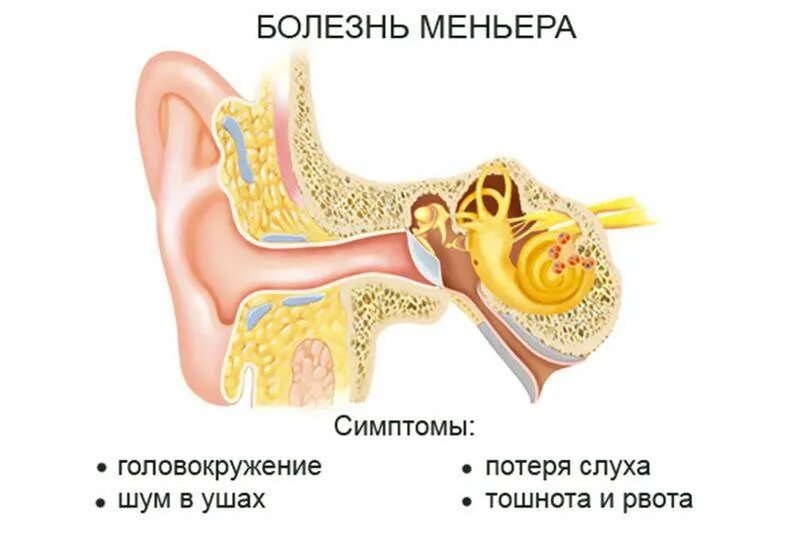 Болезнь Меньера. Воспаление среднего и внутреннего уха. Внутреннее ухо лечение и симптомы