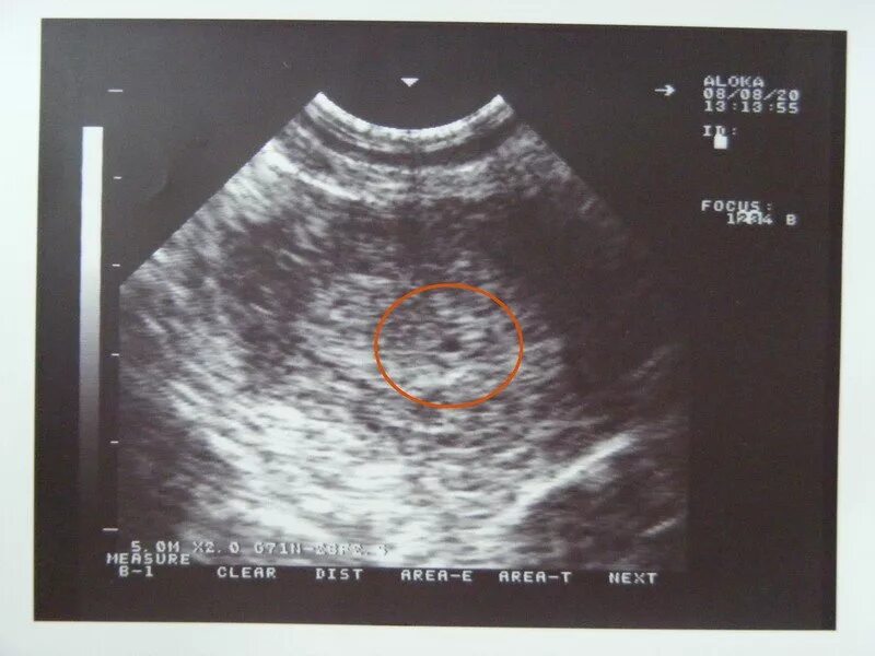 УЗИ 1-2 недели беременности. УЗИ снимок на 1,5 неделе беременности. УЗА маленький срок беременности. УЗИ 4-5 недель беременности. Узи плод 5 недель