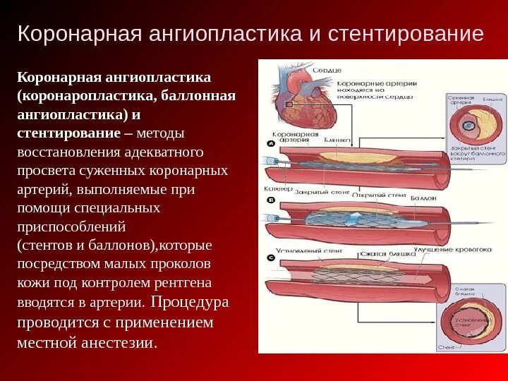 Стентирование при инфаркте. Баллонная дилатация венечных артерий. Баллонная ангиопластика и стентирование. Коронарная ангиопластика стенты. Стентирование сосудов показания.