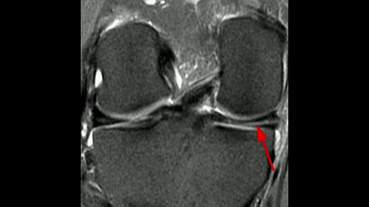 Снимок мрт коленного сустава с разрывом мениска. Мрт коленного сустава разрыв мениска. Горизонтальный разрыв мениска мрт. Мрт разрыв заднего рога мениска.