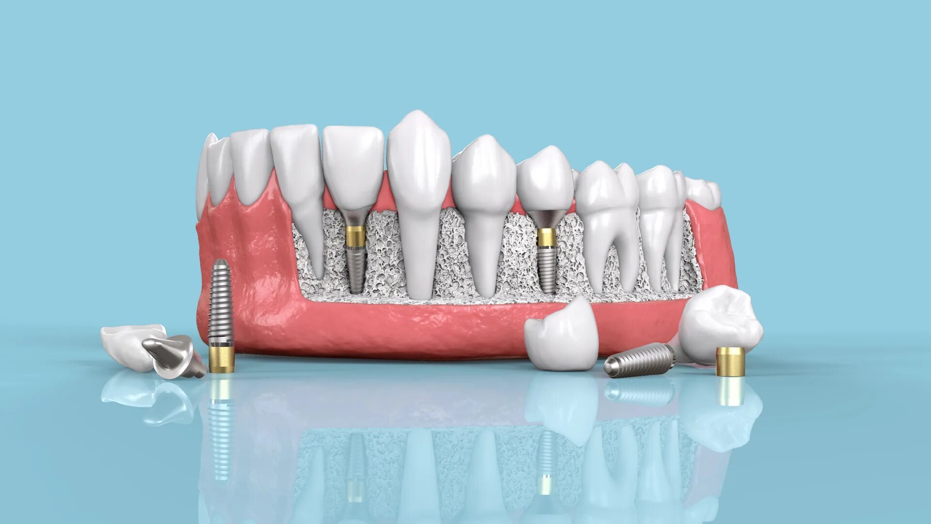 Dental implantation. Имплант osstem под ключ. Dental implantation. Дентальный имплантат. Дентальный имплантат.
