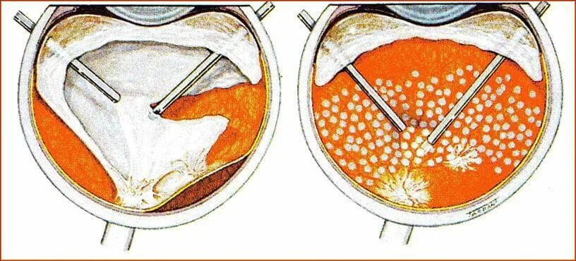 Витреолизис цена. Отслойка сетчатки витрэктомия. Витрэктомия при отслойке сетчатки. Операция витрэктомия глаза. Витрэктомия ретинопатия.