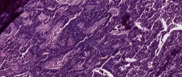 Аденокарцинома icd o 8140 3. Низкодифференцированная эндометриоидная аденокарцинома. Аденокарцинома под микроскопом. Альвеолярная ткань гистология. Аденокарцинома icd o 8140 3.