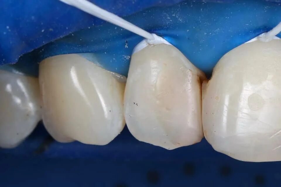 Материал для реставрации зубов. Художественное восстановление зубов. Композиты для передних зубов. Восстановление композитом зубов. Восстановление передних зубов композитным материалом.
