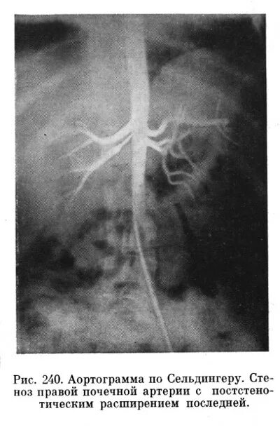 артериография по сельдингеру. катетеризация магистральных сосудов по сельдингеру. артериография по сельдингеру. ангиография по сельдингеру. караулова.