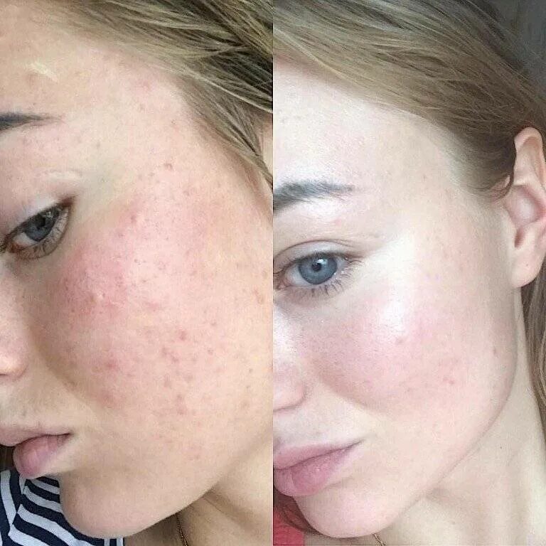 Девушка с проблемной кожей. Как предотвратить акне. Как предотвратить акне. Девушка с проблемной кожей. Папуло-пустулезные угри.