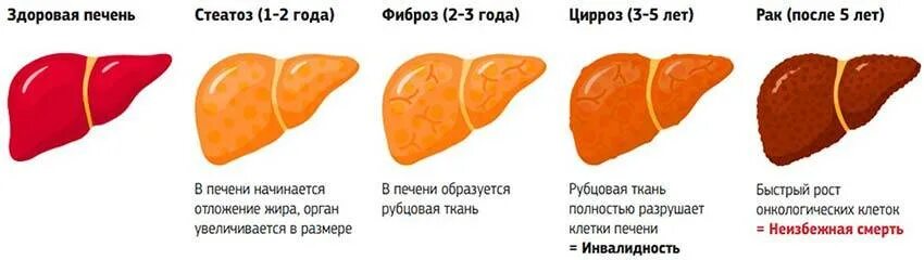 Увеличена печень форум. Фиброз гепатоз печени цирроз. Кардиогенный фиброз печени. Печень здоровая и больная.