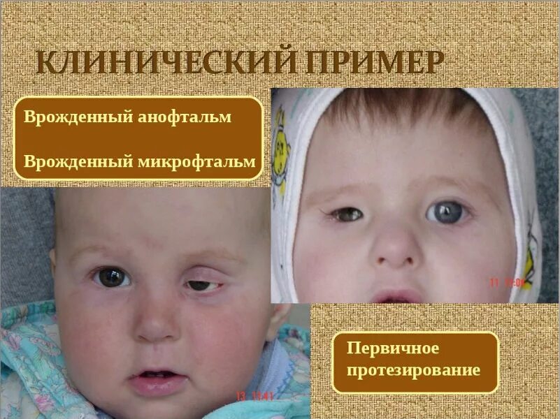 Анофтальм. Микрокорнеа микрофтальм. врожденный микрофтальм. микрофтальм анофтальм.