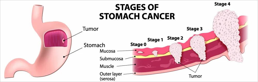 Stages of cancer