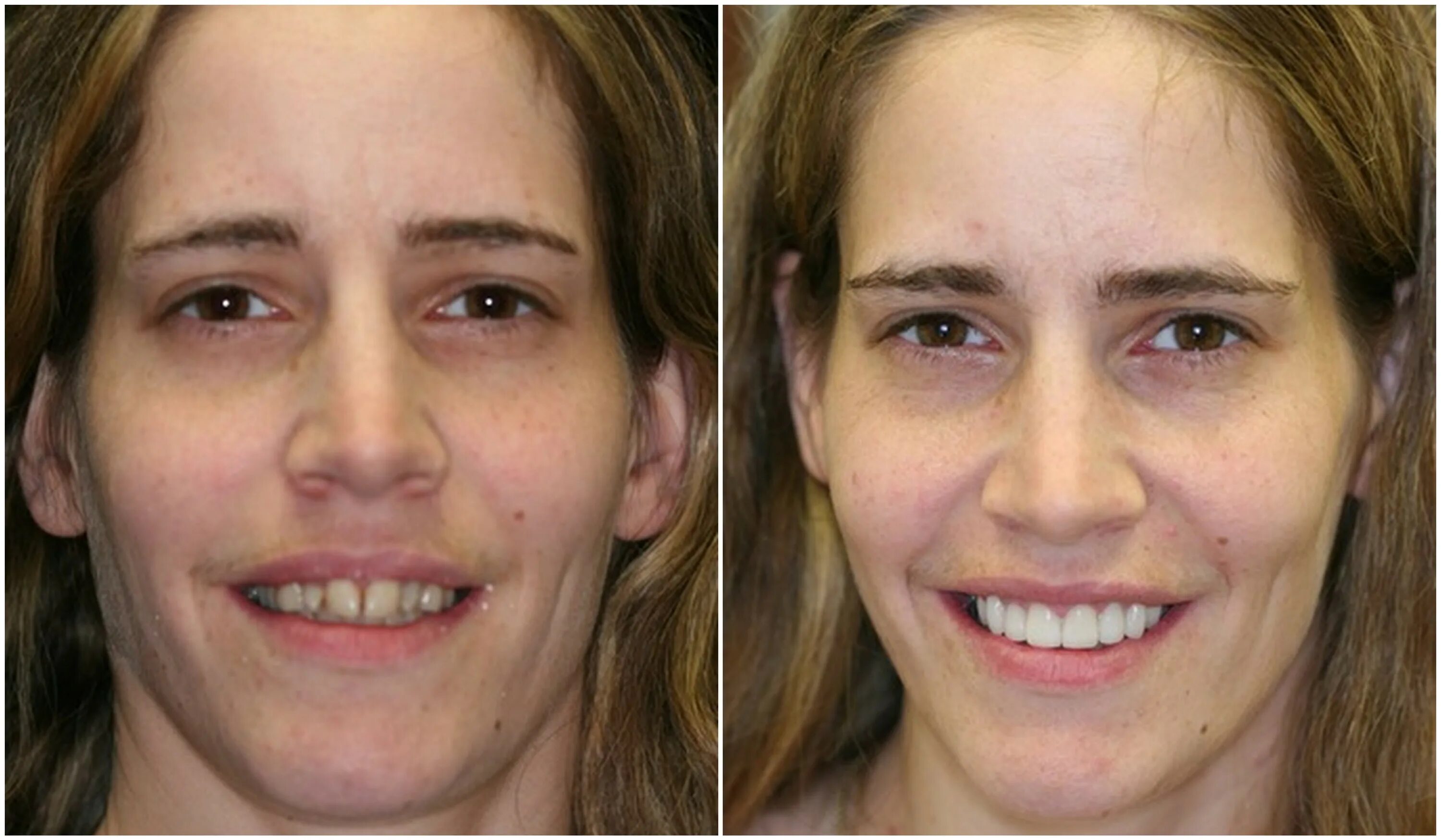 Виниры на кривые зубы до и после. Установленных до и после