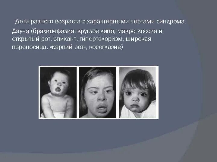Синдром дауна пороки сердца. Фенотипические проявления синдрома дауна. макроглоссия у детей с синдромом дауна. дети разного возраста с характерными чертами синдрома дауна. наследственные заболевания человека синдром дауна.